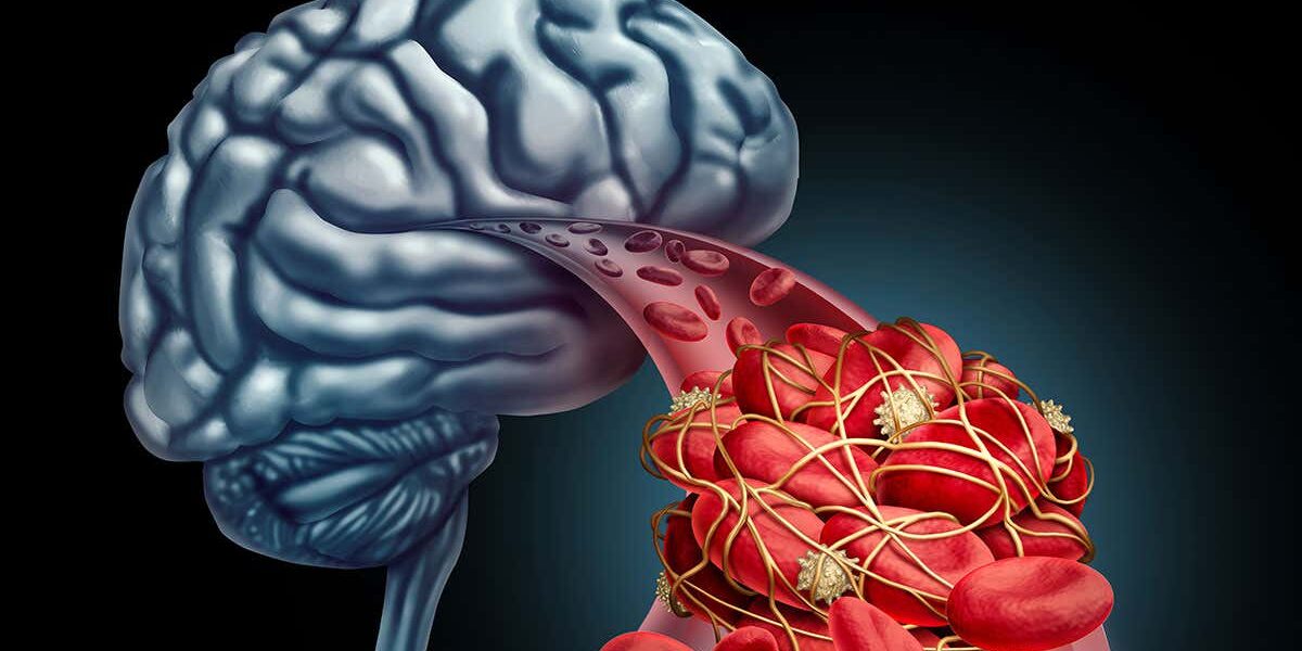 rates-of-death-after-stroke-have-fallen-by-a-quarter-in-south-london rates-of-death-after-stroke-have-fallen-by-a-quarter-in-south-london