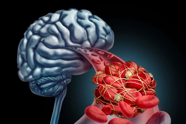 rates-of-death-after-stroke-have-fallen-by-a-quarter-in-south-london rates-of-death-after-stroke-have-fallen-by-a-quarter-in-south-london