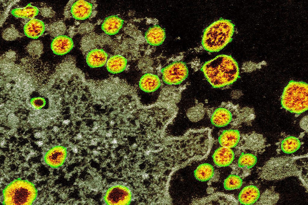 can-you-catch-the-coronavirus-twice?-we-don’t-know-yet