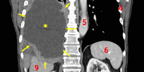 Tumor_Mesothelioma2_legend Risk of Cancer